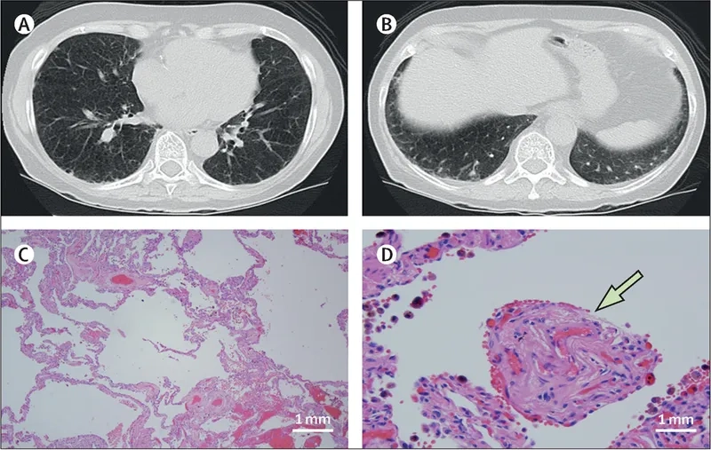 How pulmonary hypertension is diagnosed clinically