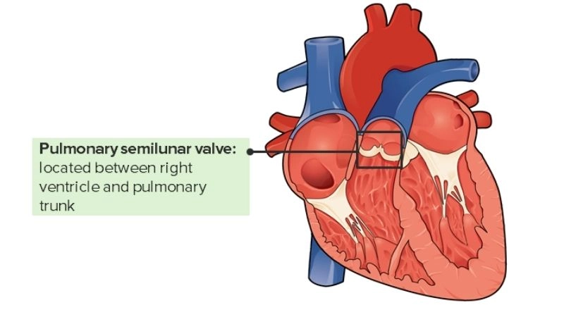 Pulmonary regurgitation heart murmur aids diagnosis
