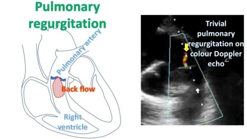 Common after tetralogy of Fallot repair