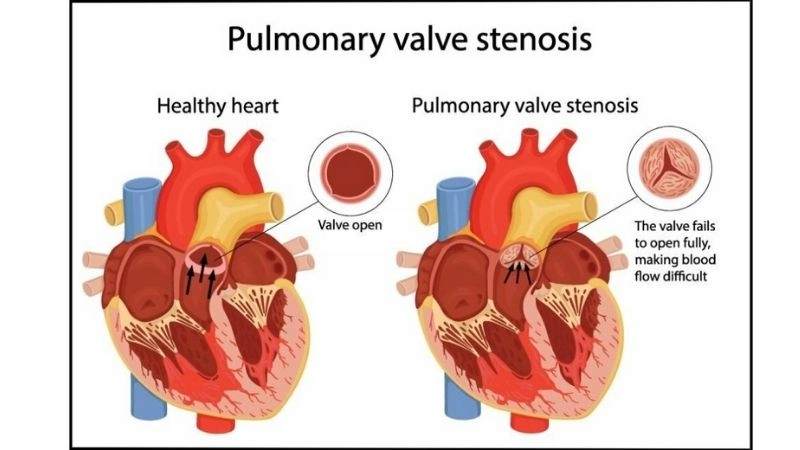 Pulmonary Stenosis Treatment ranges from monitoring to surgery