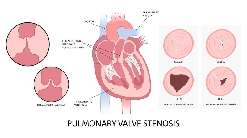 What Is Pulmonary Stenosis explained in clear terms
