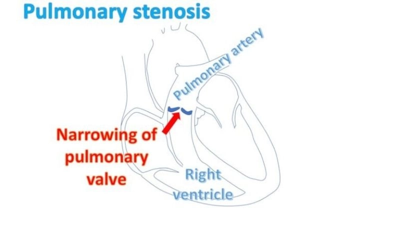 Pulmonary Stenosis In Adults may remain undetected for years