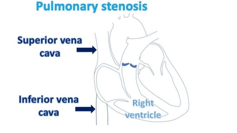 Pulmonary Stenosis Echo helps confirm valve narrowing