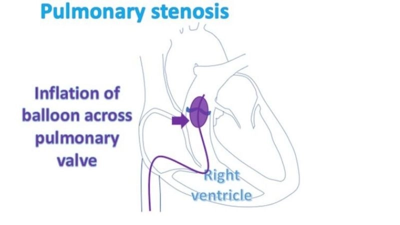 Mild Pulmonary Stenosis usually needs regular follow-ups