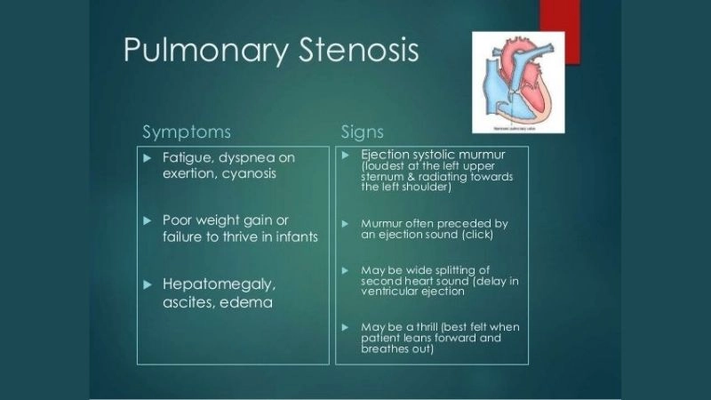 Severe Pulmonary Stenosis can cause right heart failure