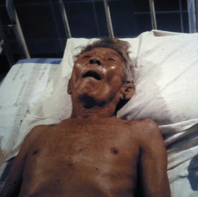 Rabies causes infection from animal bites