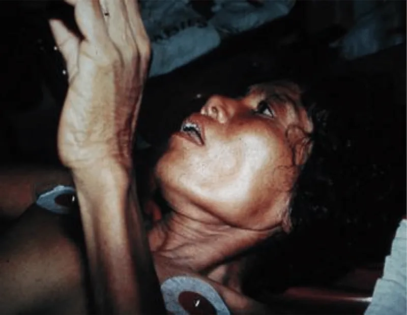 Rabies affects human nervous system severely