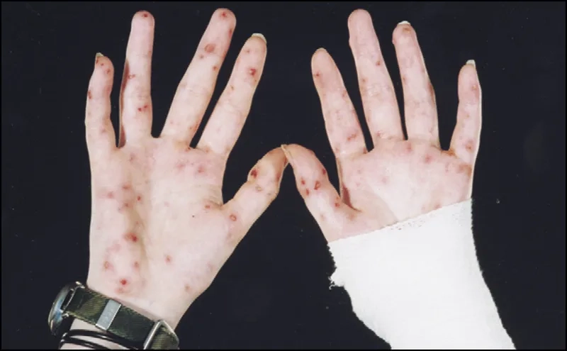 Clinical signs associated with Sodoku disease