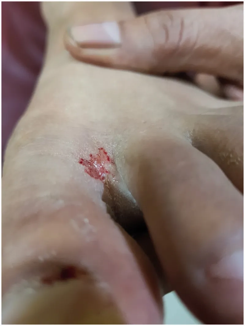 Medical team providing treatment for rat-bite fever