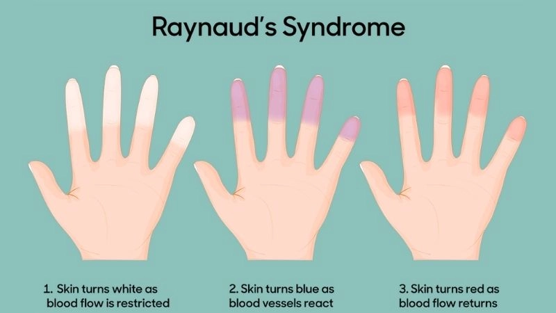 Raynaud's phenomenon symptoms and warning signs