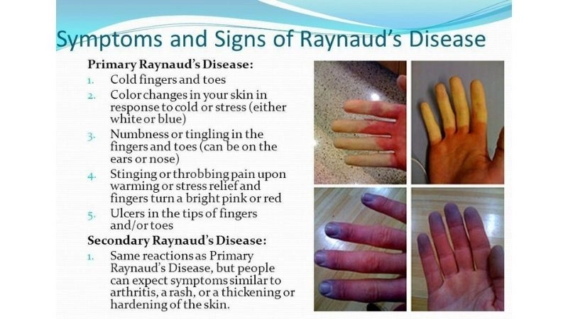 Raynaud's phenomenon treatment for better relief