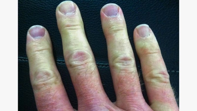 Raynaud's phenomenon causes and risk factors