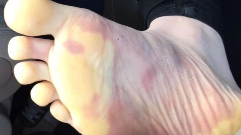 Raynaud's phenomenon diagnosis with medical tests