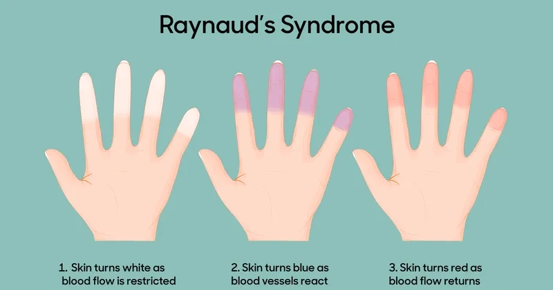 An infographic showing the primary causes of Raynaud's