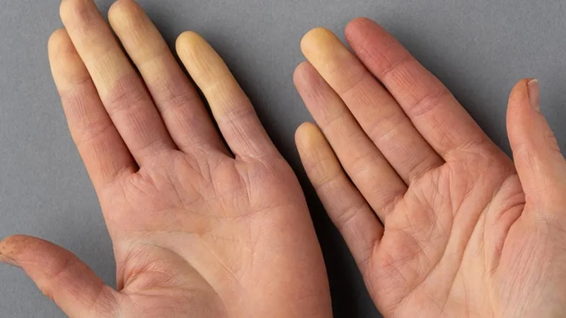 Underlying conditions that cause secondary Raynaud's