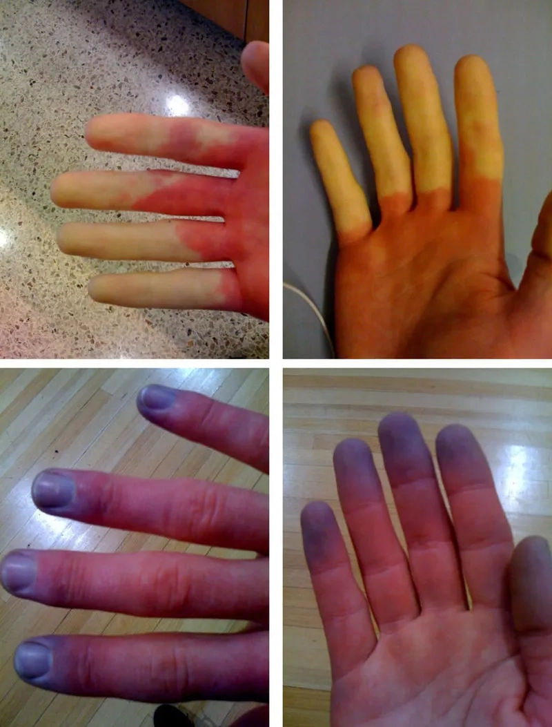 Practical lifestyle tips for living with Raynaud's