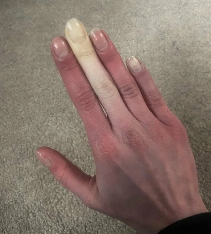 The clinical presentation of Raynaud's syndrome