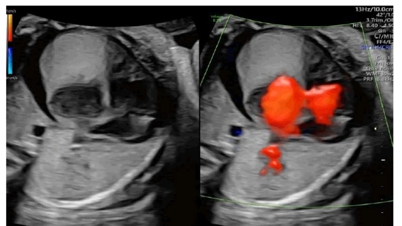 Medical view of rhabdomyoma symptoms clearly shown