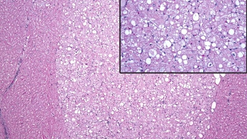 Detailed look at cardiac rhabdomyoma condition