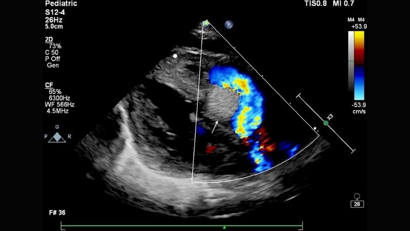 Precise image for rhabdomyoma diagnosis clarity