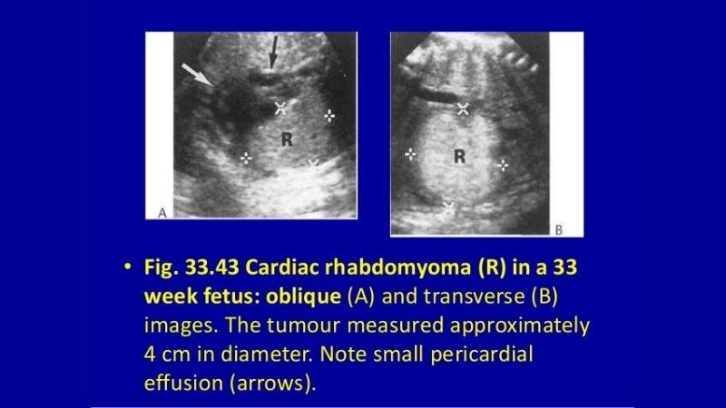 Fascinating process of rhabdomyoma regression