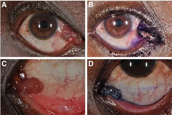 Microscopic view of Rhinosporidium seeberi