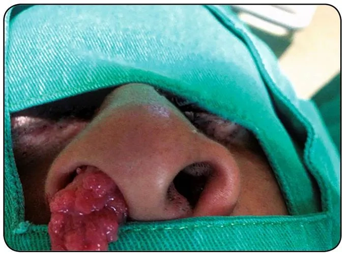The process of surgical excision for rhinosporidiosis