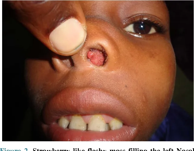 Mapping areas where the disease is endemic in India and Sri Lanka