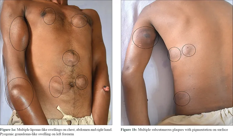 A clinical view of the strawberry-like nasal mass