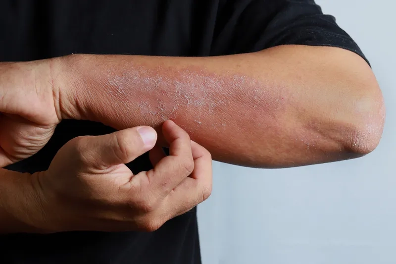 The typical appearance of ringworm in humans on the arm