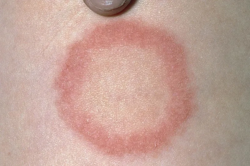 Medical advice on how to get rid of ringworm fast