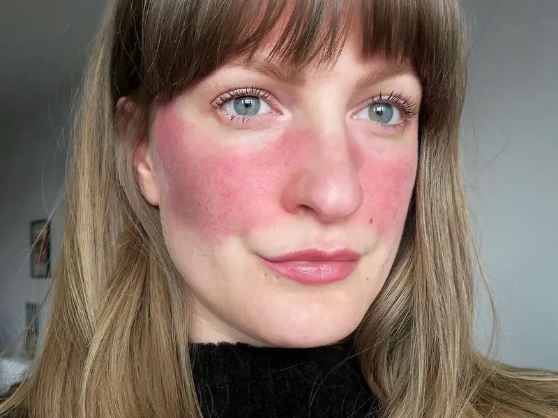 Rosacea symptoms on sensitive facial skin