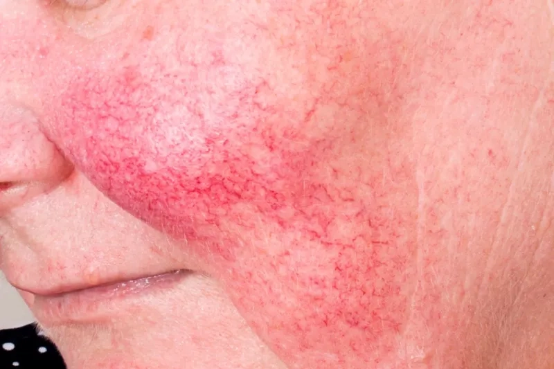 Effective rosacea treatment options explained