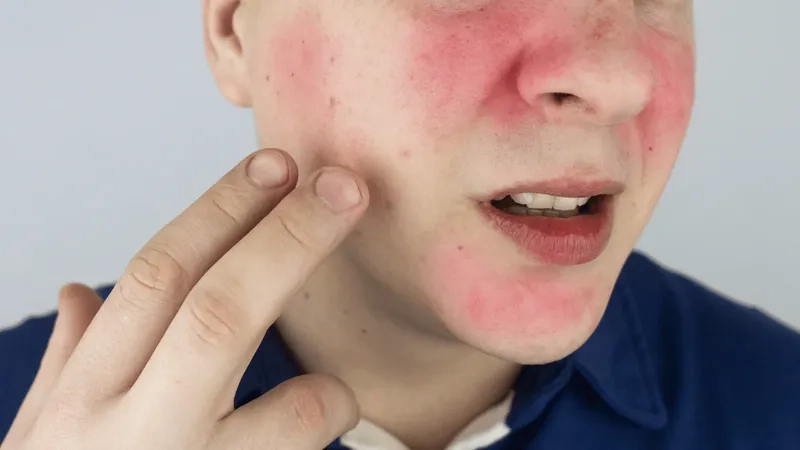 What is rosacea and how it affects skin