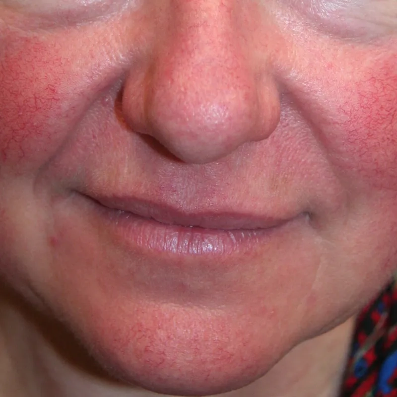 Common rosacea triggers to avoid daily