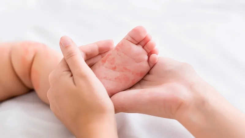Recognizing roseola symptoms in babies