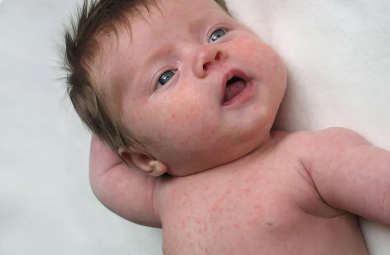Comparing roseola vs measles rashes 