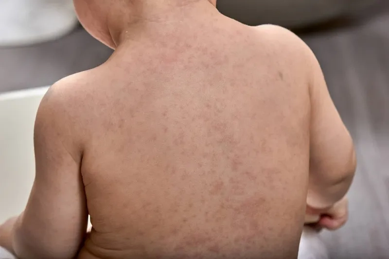 A visual guide to the classic roseola rash