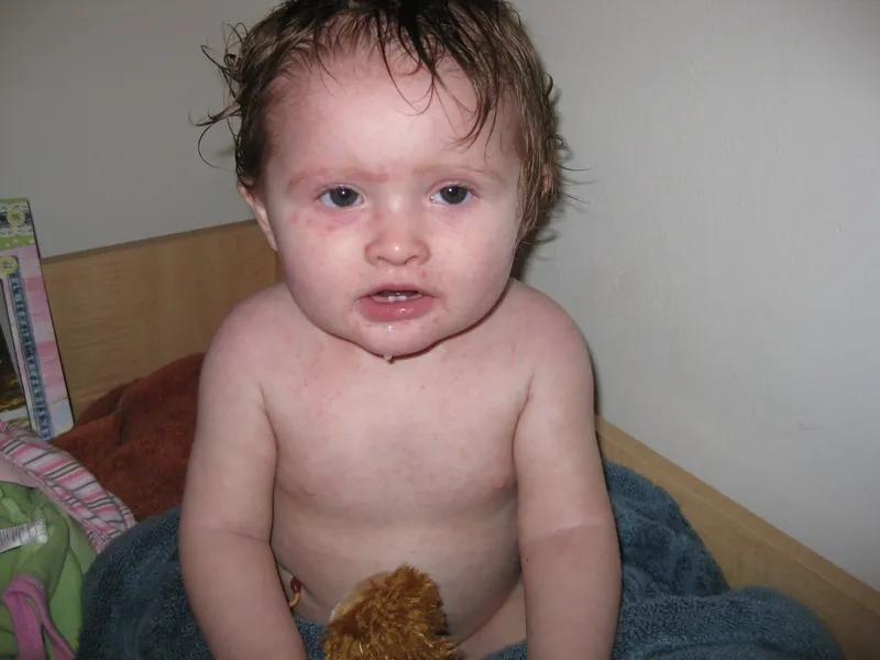 A clear explanation of what is roseola