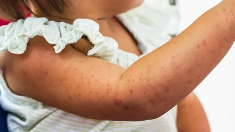 Roseola Infantum linked to Human herpesvirus 6