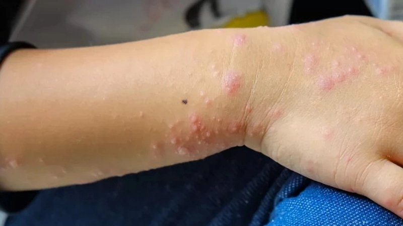 Roseola Infantum needs Roseola treatment advice