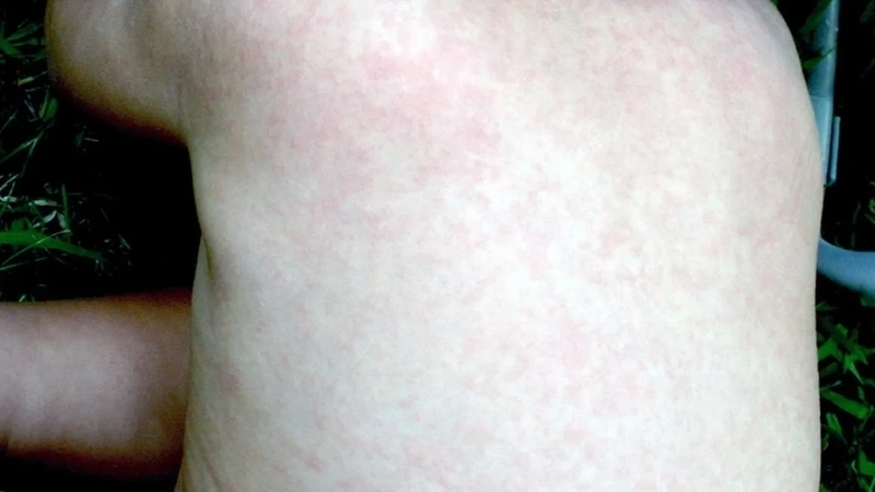 Roseola Infantum seen in Roseola in babies