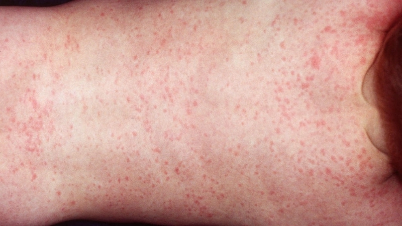 Roseola Infantum occurs as Roseola in toddlers