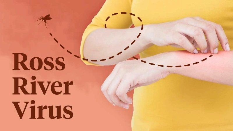 Ross River Fever linked to Ross River virus