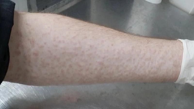 Ross River Fever needs Ross River virus vaccine