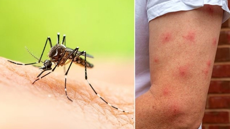 Ross River Fever spread by fever transmission