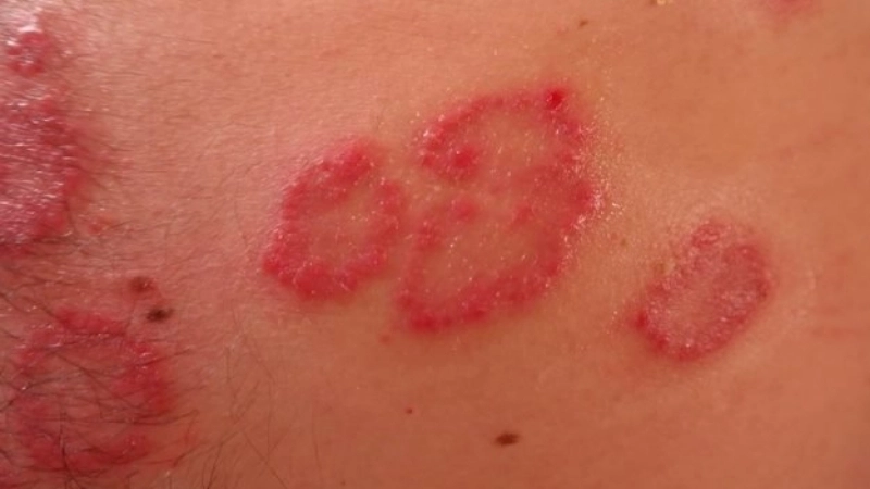 Rubella virus spreads German measles