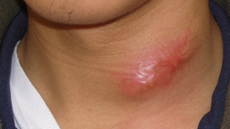 Sapovirus Infection shows Sapovirus symptoms