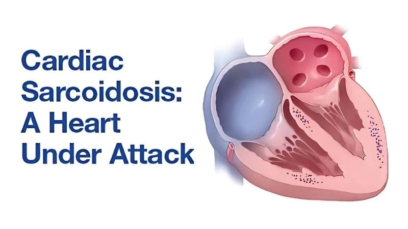 Sarcoidosis of the heart symptoms warning signs of heart involvement