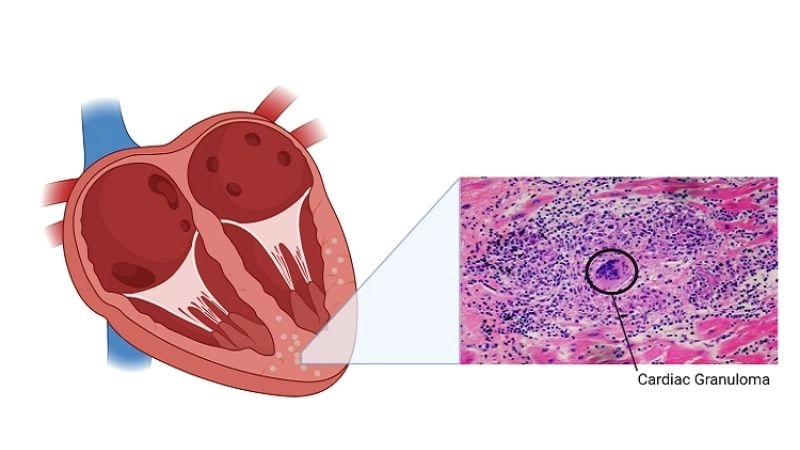 Cardiac sarcoidosis diagnosis early detection is critical for care
